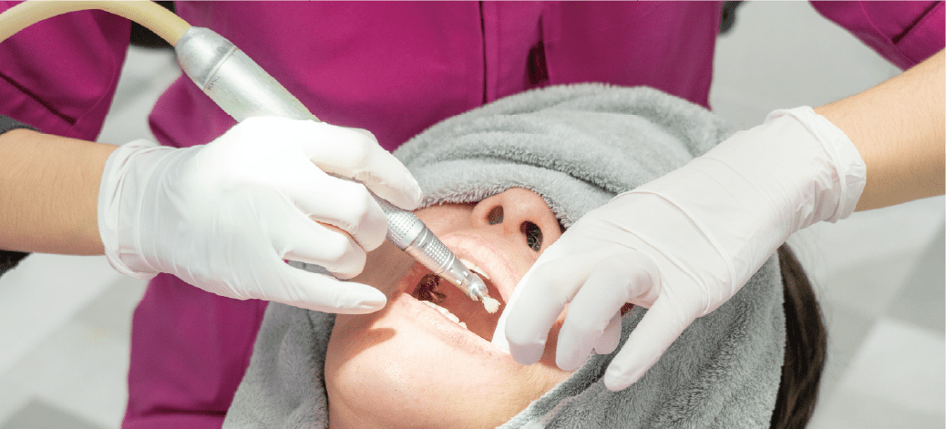 歯のクリーニングの画像