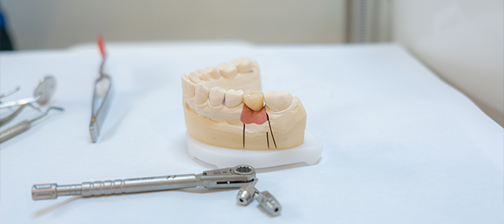 人工歯の取り付け後の画像