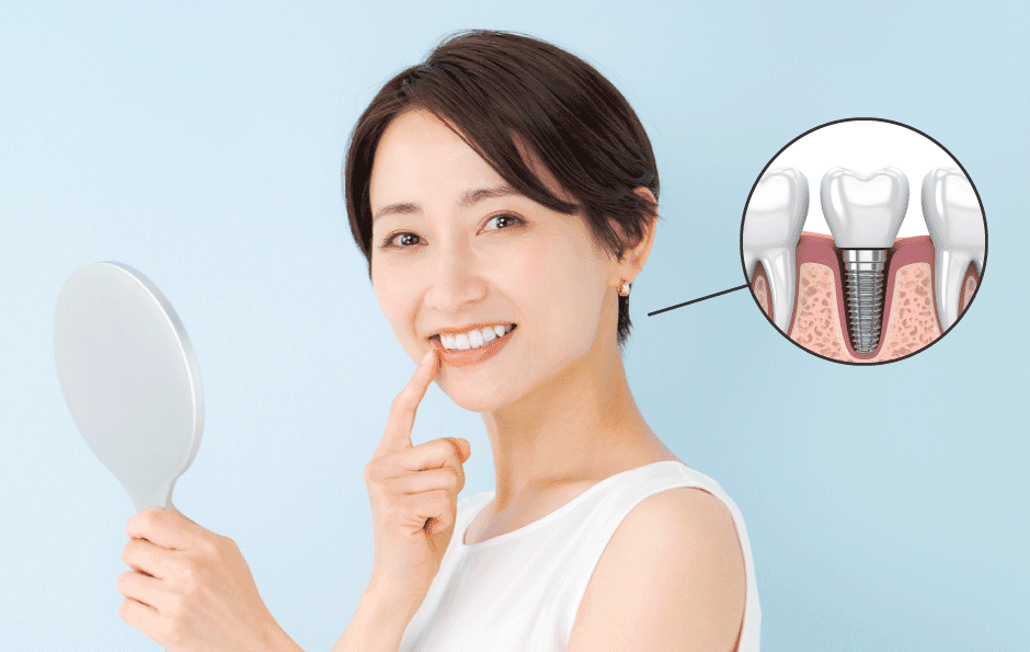 インプラント治療のイメージ写真