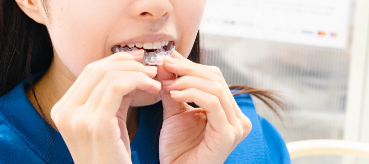 ホームホワイトニング用 マウスピース装着の様子