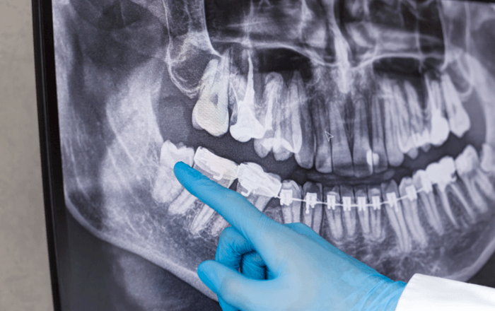 親知らずのレントゲン写真