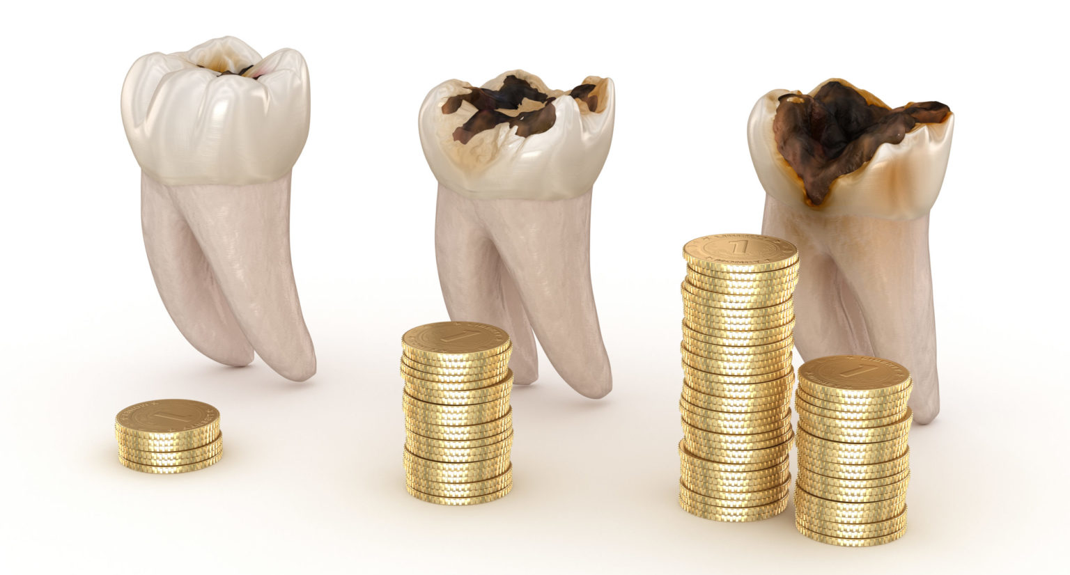 虫歯の治療費用っていくらぐらい？ | 虫歯の進行度と治療内容等による費用の違い