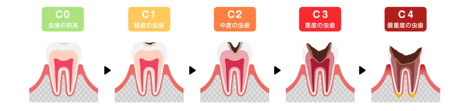 虫歯の治療は進行状態で変わります | 虫歯の治療方法