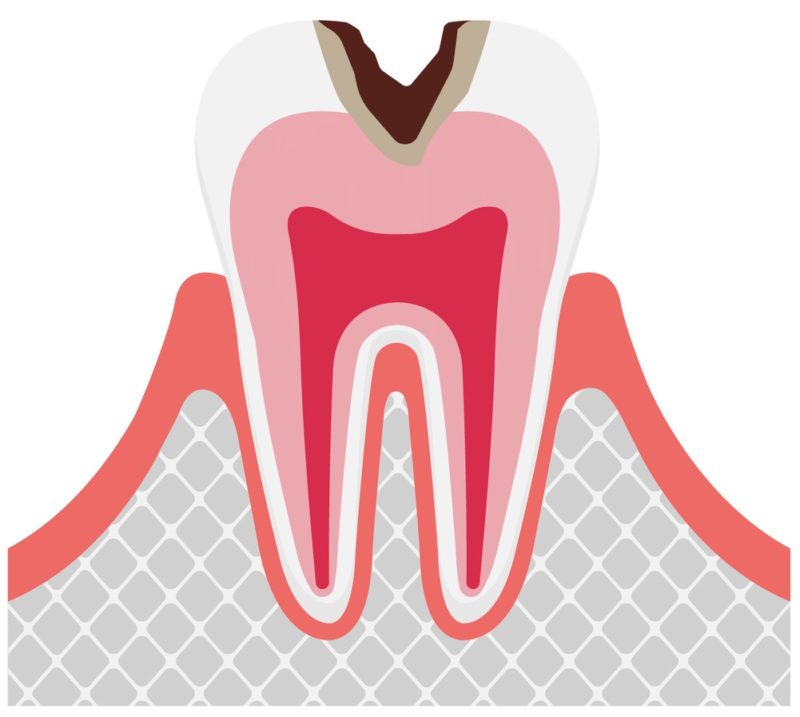 歯のエナメル質が溶けた段階