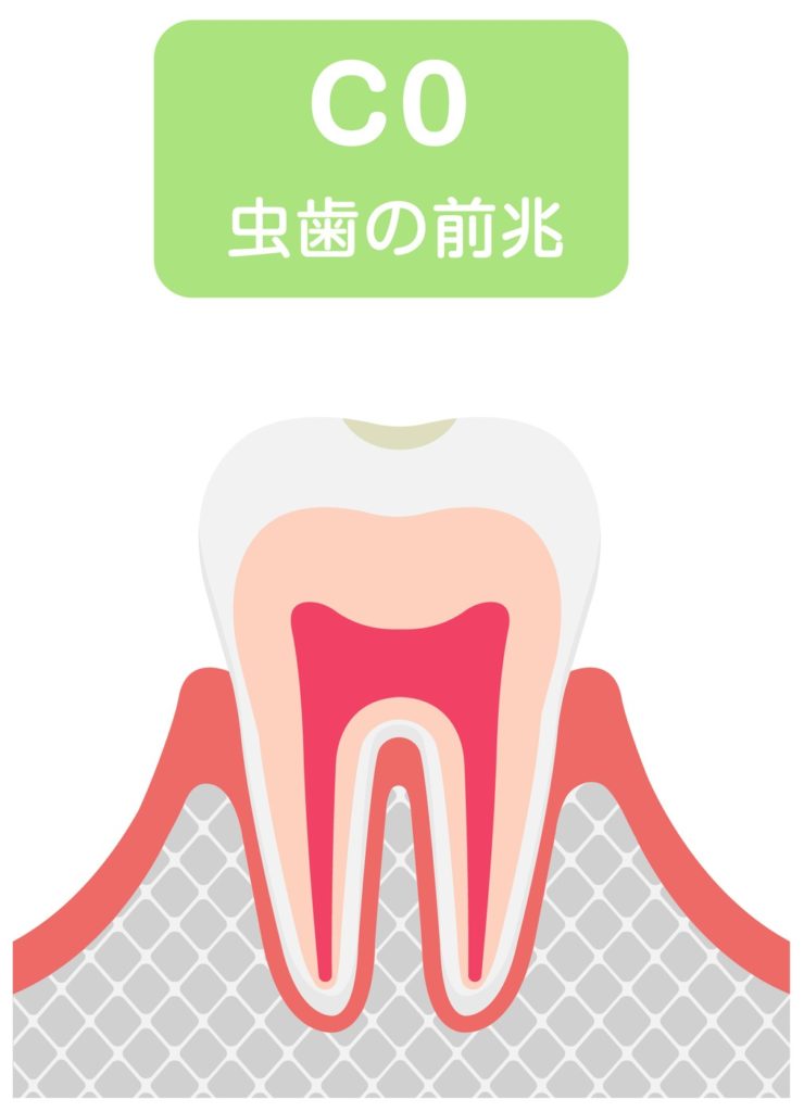進行状態「C0」：歯の表面のエナメル質が溶け始めた段階
