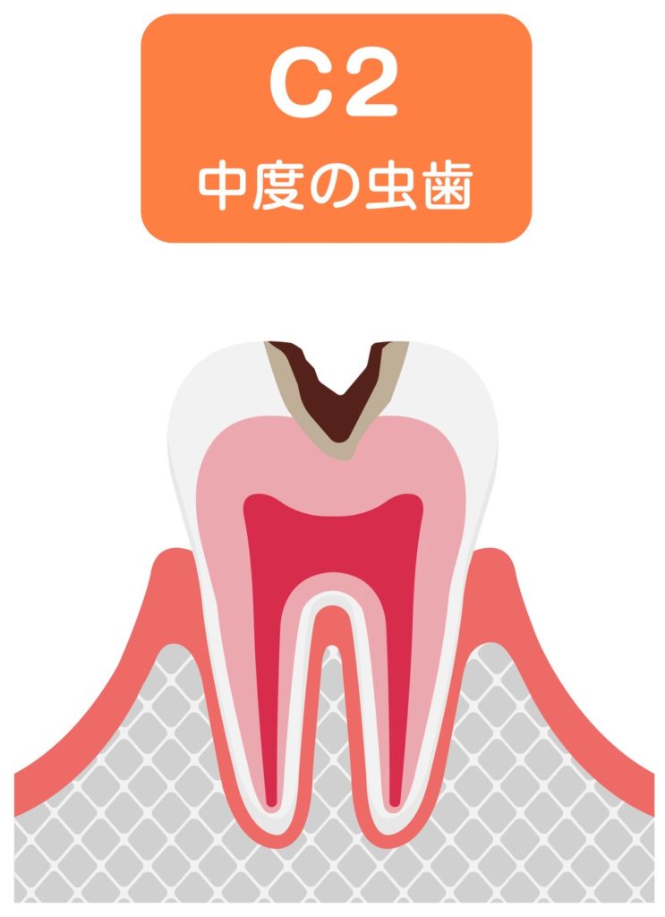 進行状態「C2」：虫歯が歯の象牙質まで進行している段階