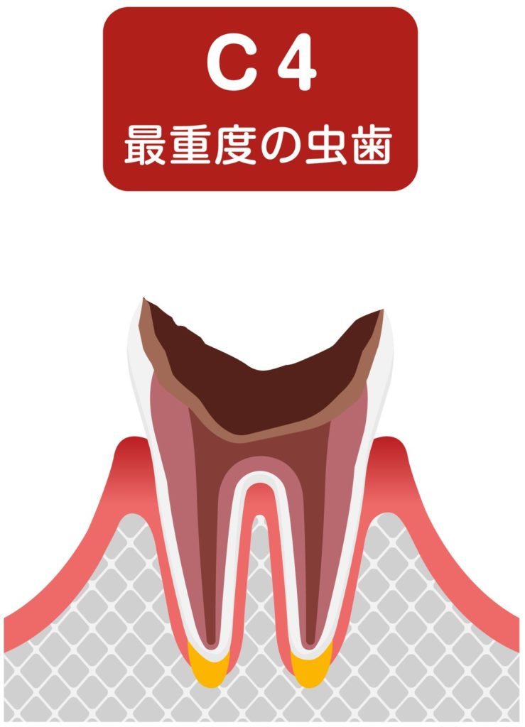 進行状態「C4」：大きな穴が空き、ほとんど歯を失った歯冠の段階