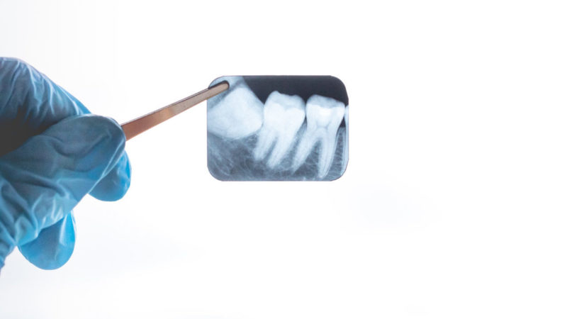 親知らずの隣の歯が虫歯になりやすい？ | 奥歯の第二大臼歯への影響