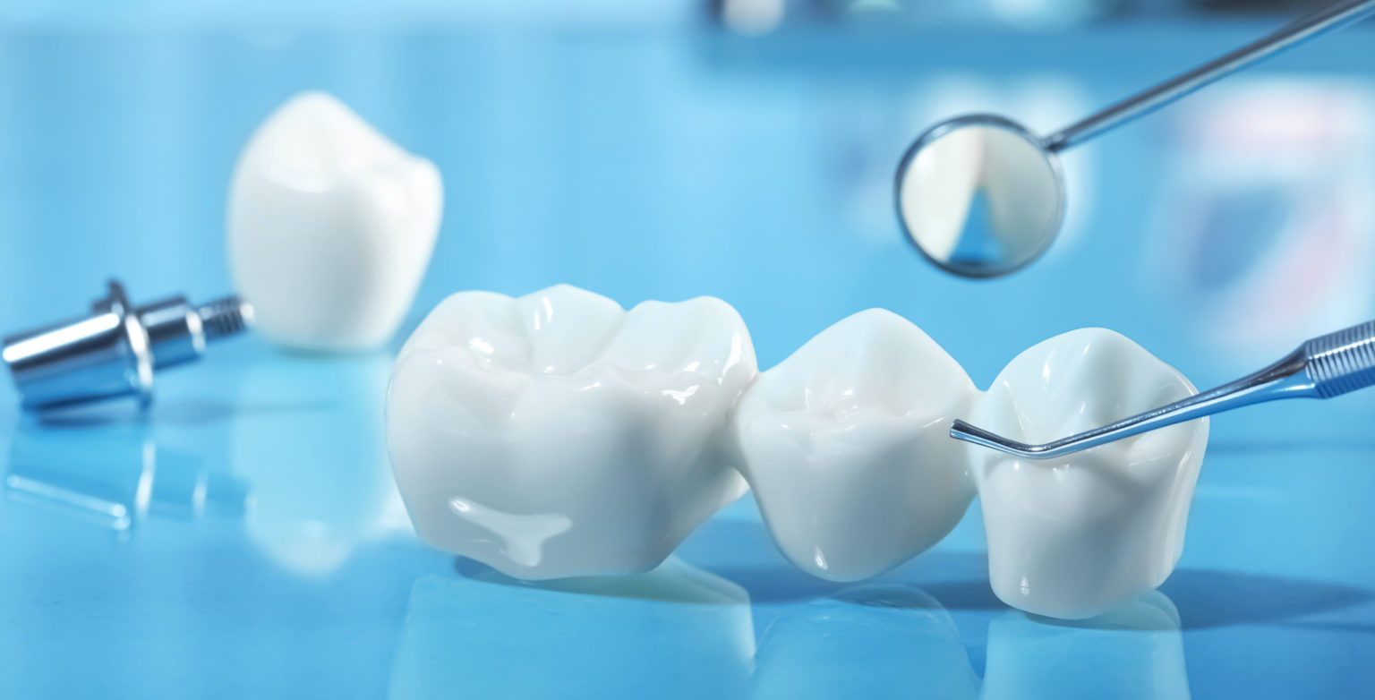 人工歯を入れる方法にはどんな種類があるの？ | インプラントとブリッジと入れ歯の違い