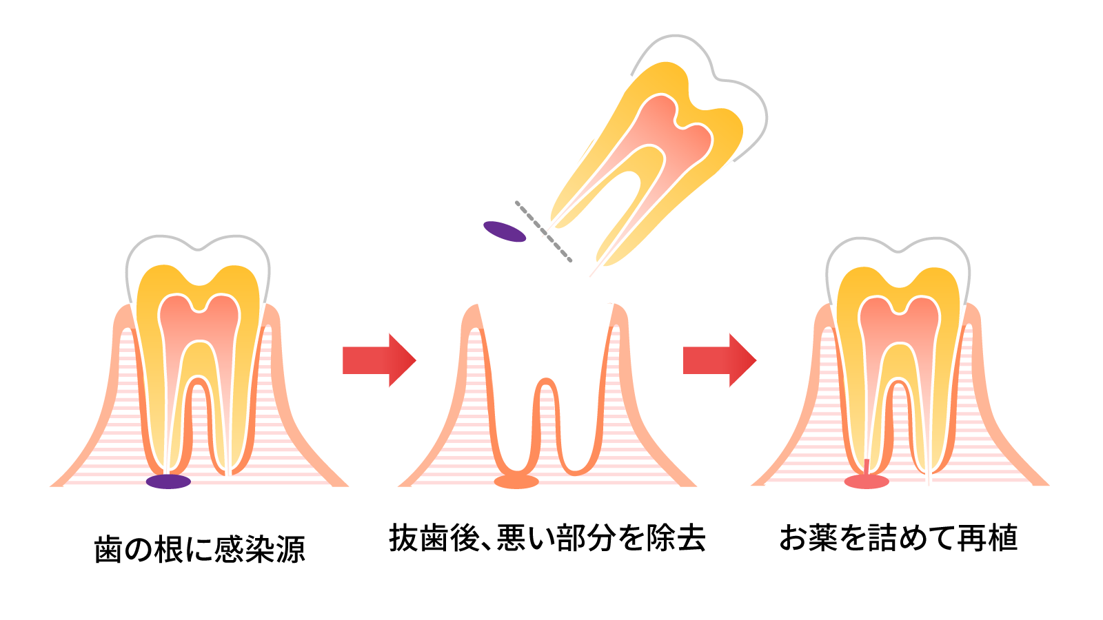 一度歯を抜いて元に戻す？意図的再植とは | コンパスメディカルグループ｜医科歯科健診コラム
