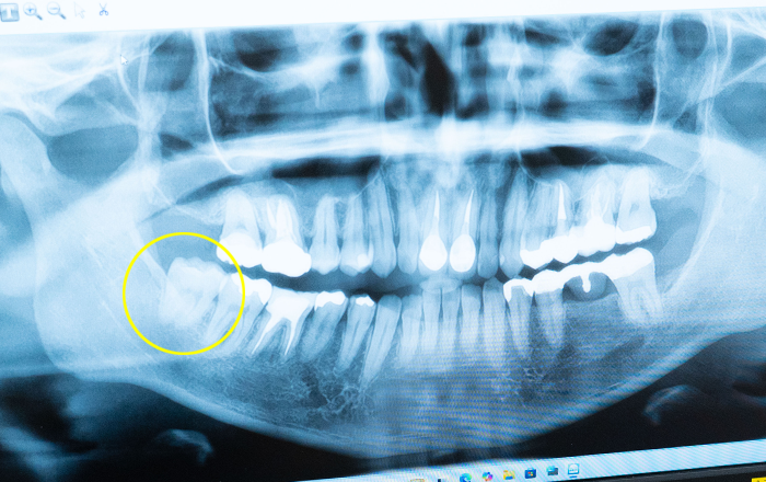 親知らずのレントゲン写真