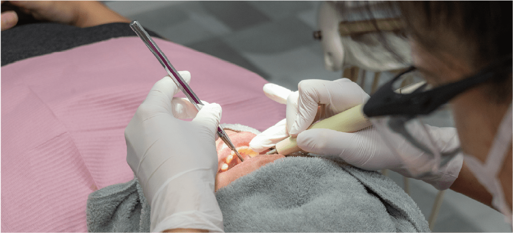 歯のクリーニングの画像