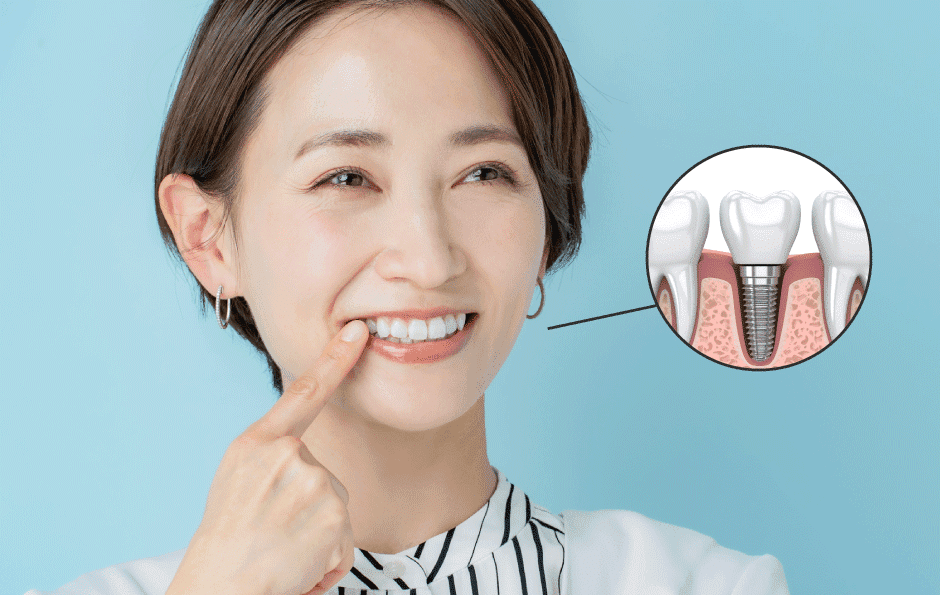 インプラント治療のイメージ写真
