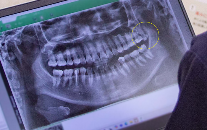 親知らずのレントゲン写真