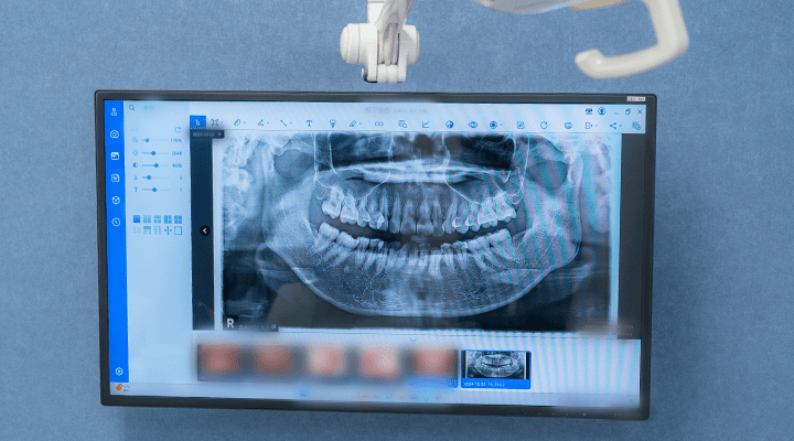 レントゲン画像を映すモニター