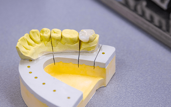 セラミックの被せ物写真