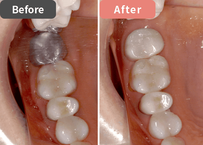 セラミック治療の症例写真